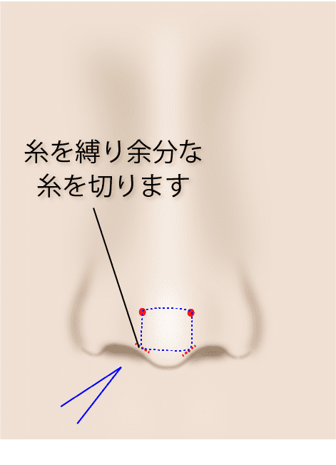 ③余分な糸を切る